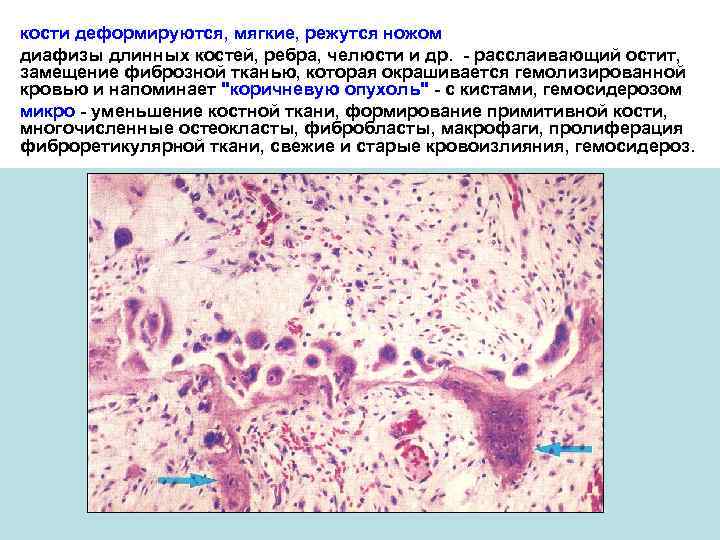 кости деформируются, мягкие, режутся ножом диафизы длинных костей, ребра, челюсти и др. - расслаивающий