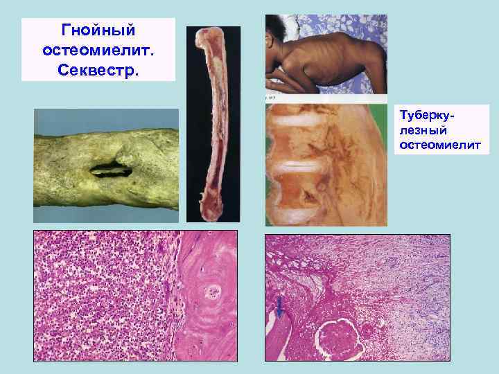 Гнойный остеомиелит. Секвестр. Туберкулезный остеомиелит 