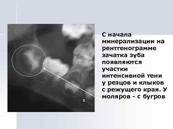 Рентгенологическая картина зубов и их зачатков на различных этапах формирования