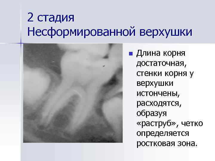 Рентгенологическая картина зубов и их зачатков на различных этапах формирования