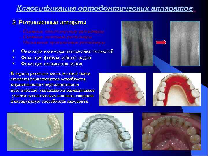 Ретенционные аппараты презентация