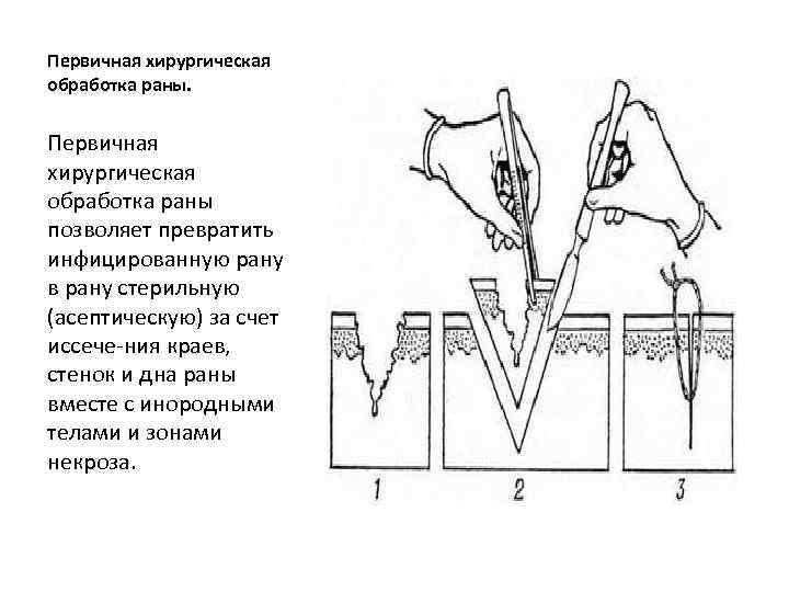 Первичная хирургическая обработка ран. Схема первичной хирургической обработки раны. Протокол первичной хирургической обработки раны. Пхо раны антисептики.