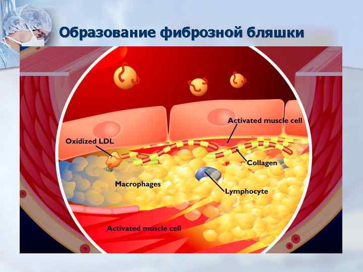 Образование фиброзной бляшки 