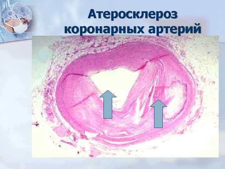 Атеросклероз коронарных артерий 