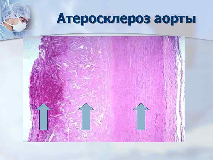Атеросклероз аорты 