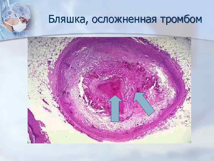 Бляшка, осложненная тромбом 