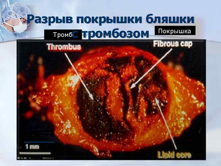 Разрыв покрышки бляшки Покрышка Тромбс тромбозом 