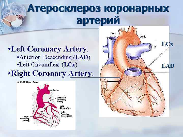 Увеличение легочной аорты