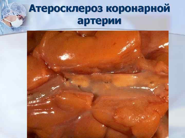 Атеросклероз коронарной артерии 