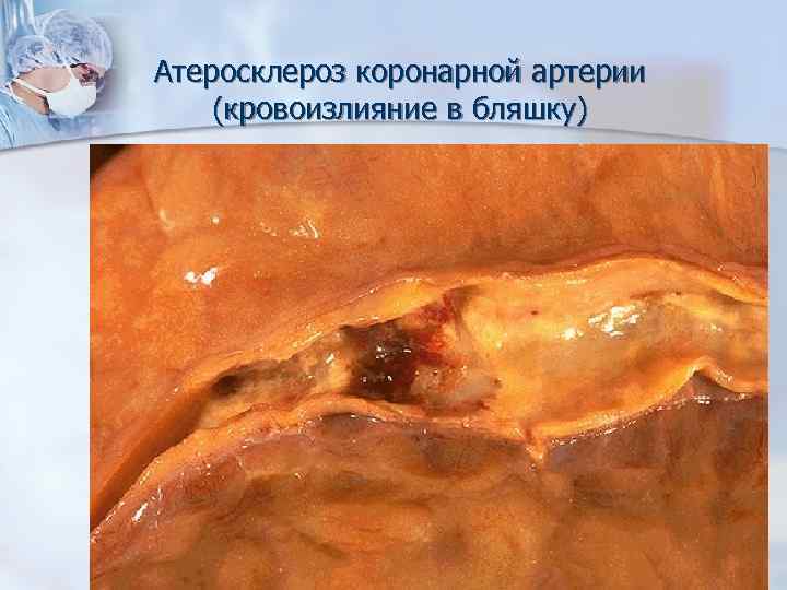 Атеросклероз коронарной артерии (кровоизлияние в бляшку) 