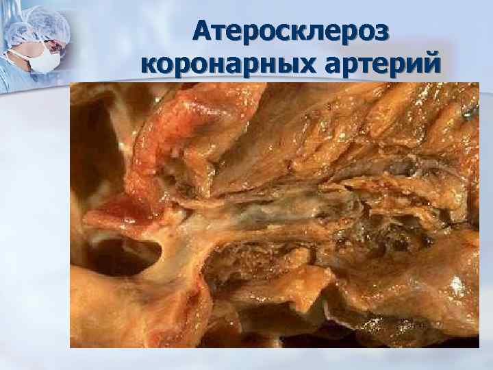 Атеросклероз коронарных артерий 