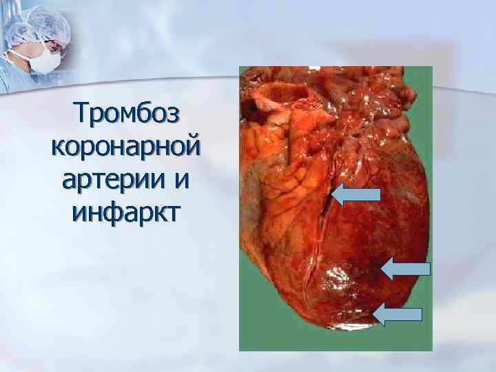 Тромбоз коронарной артерии и инфаркт 