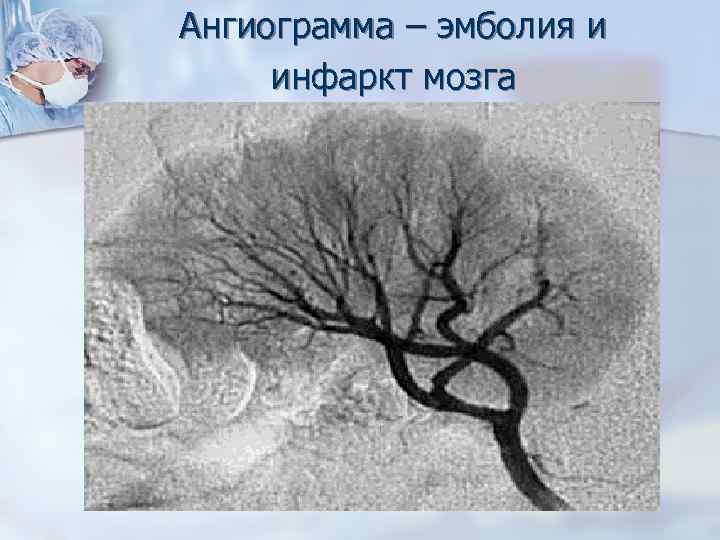 Ангиограмма – эмболия и инфаркт мозга 