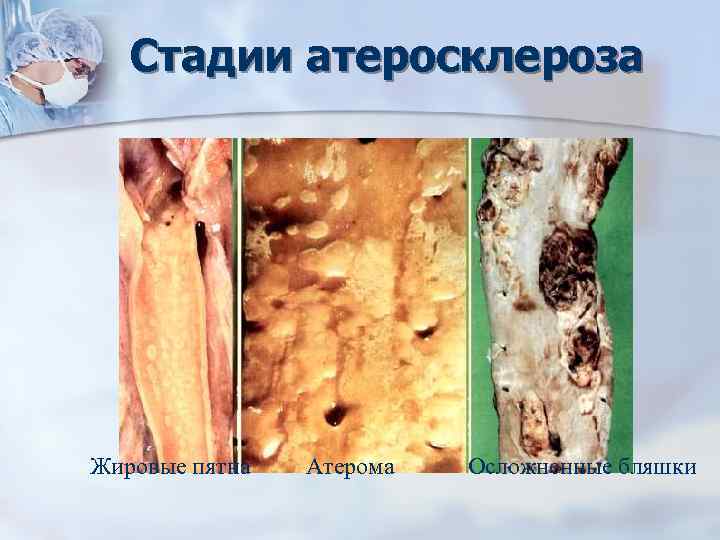 Стадии атеросклероза Жировые пятна Атерома Осложненные бляшки 