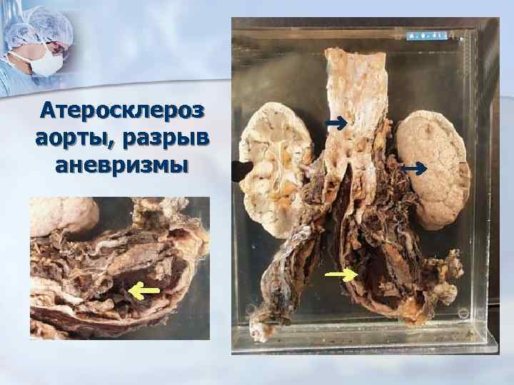 Атеросклероз аорты, разрыв аневризмы 