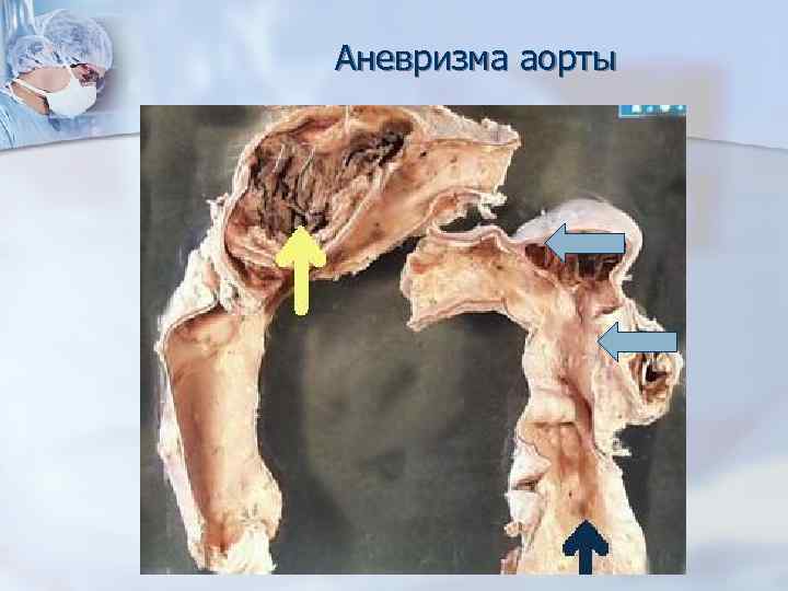 Аневризма аорты 
