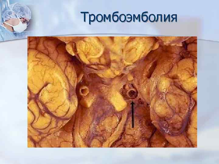 Тромбоэмболия 