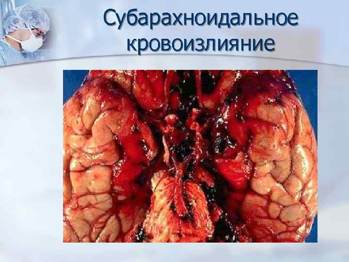 Субарахноидальное кровоизлияние 
