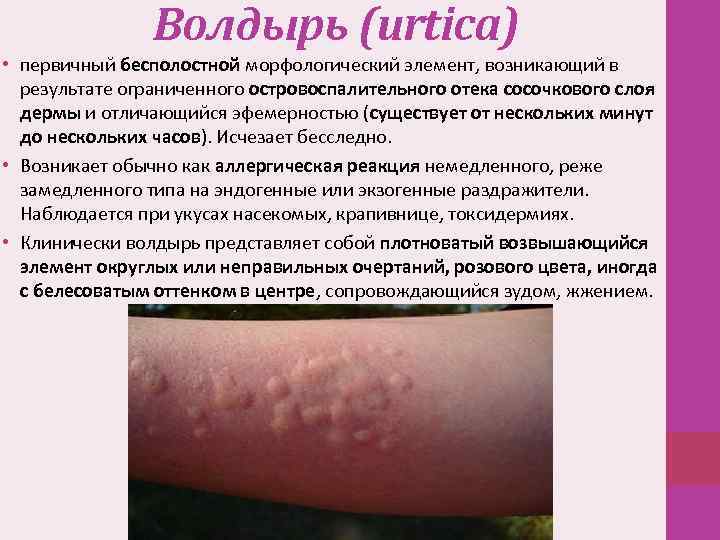 Волдырь (urtica) • первичный бесполостной морфологический элемент, возникающий в результате ограниченного островоспалительного отека сосочкового