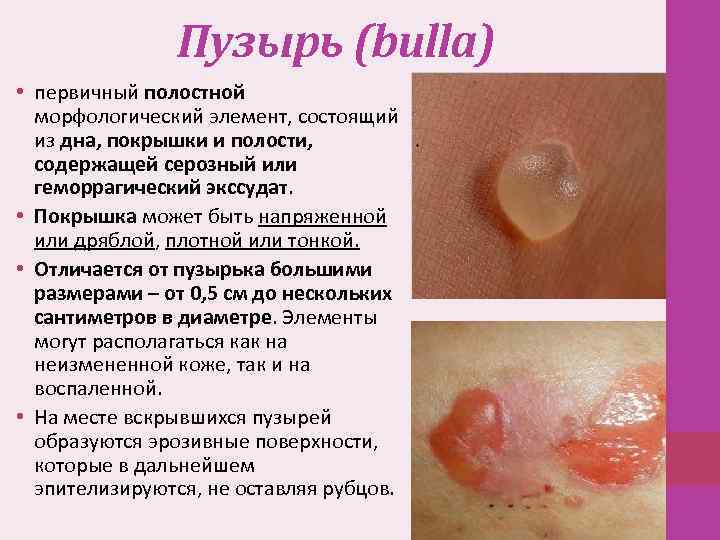 Пузырь (bulla) • первичный полостной морфологический элемент, состоящий из дна, покрышки и полости, содержащей