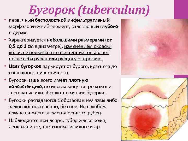 Бугорок (tuberculum) • первичный бесполостной инфильтративный морфологический элемент, залегающий глубоко в дерме. • Характеризуется