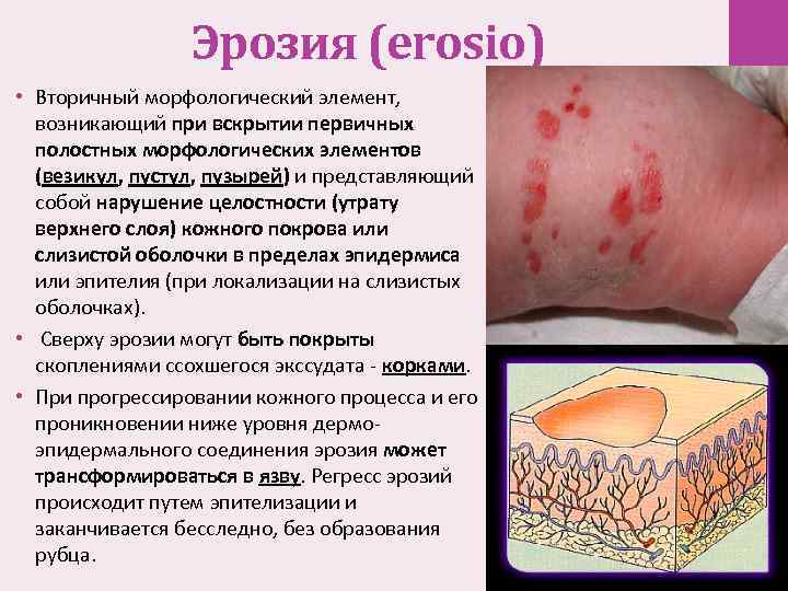 Эрозия (erosio) • Вторичный морфологический элемент, возникающий при вскрытии первичных полостных морфологических элементов (везикул,