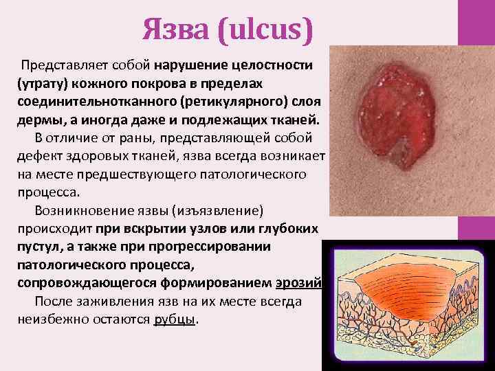 Язва (ulcus) Представляет собой нарушение целостности (утрату) кожного покрова в пределах соединительнотканного (ретикулярного) слоя