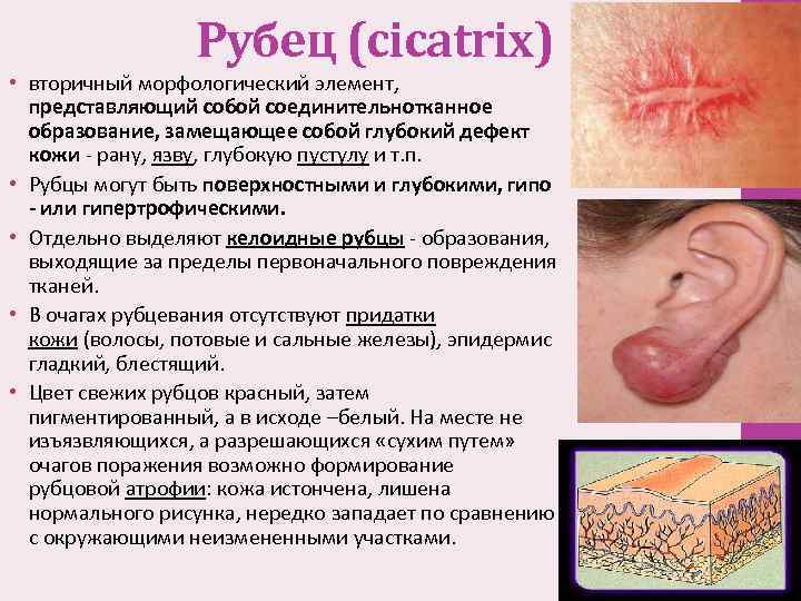 Рубец (cicatrix) • вторичный морфологический элемент, представляющий собой соединительнотканное образование, замещающее собой глубокий дефект