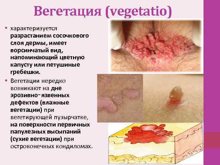 Вегетация (vegetatio) • характеризуется разрастанием сосочкового слоя дермы, имеет ворсинчатый вид, напоминающий цветную капусту