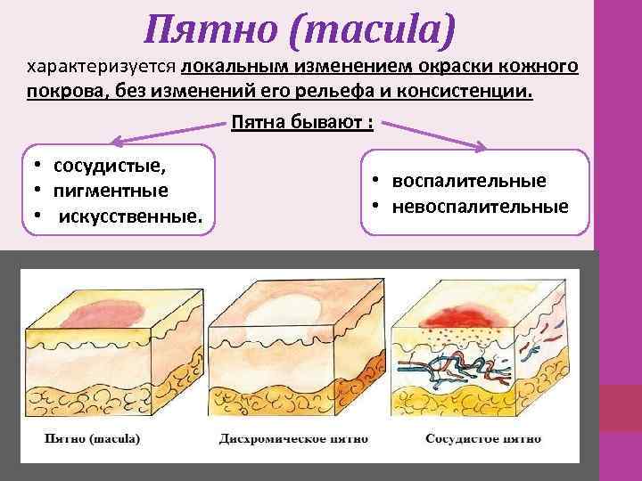 Пятно (macula) характеризуется локальным изменением окраски кожного покрова, без изменений его рельефа и консистенции.