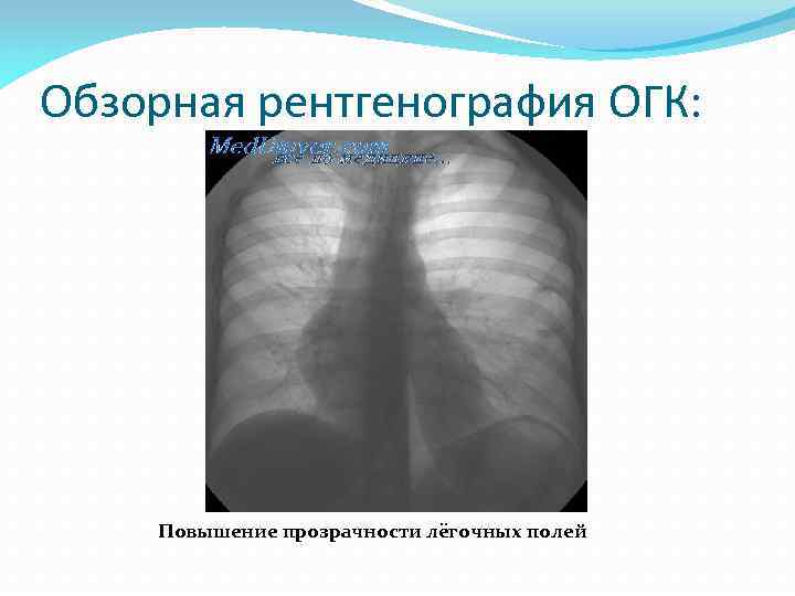 Огк это. Обзорная рентгенография ОГК. Рентгенография органов грудной клетки. Обзорная рентгенография органов грудной клетки. Обзорная рентгенография окн.