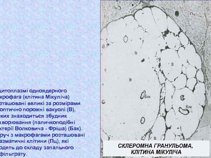 цитоплазмі одноядерного крофага (клітина Мікуліча) зташовані великі за розмірами оптично порожні вакуолі (В), яких