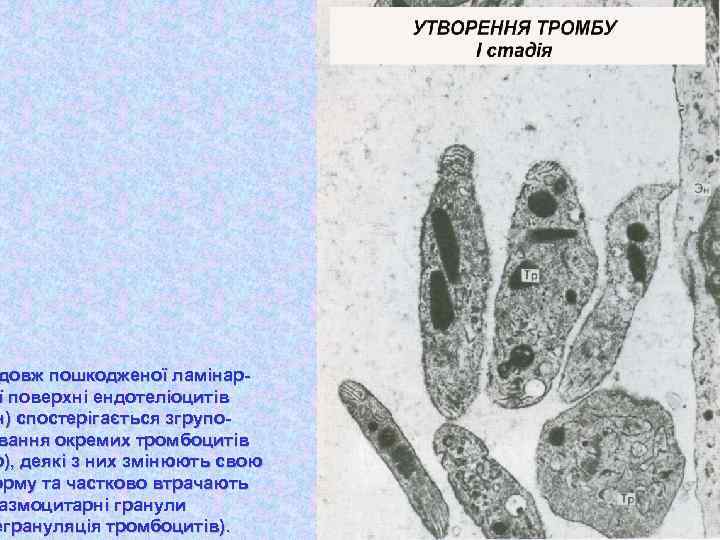довж пошкодженої ламінарї поверхні ендотеліоцитів н) спостерігається згруповання окремих тромбоцитів р), деякі з них