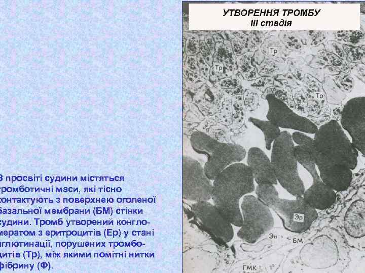 В просвіті судини містяться тромботичні маси, які тісно контактують з поверхнею оголеної базальної мембрани
