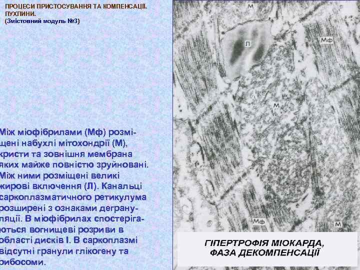 ПРОЦЕСИ ПРИСТОСУВАННЯ ТА КОМПЕНСАЦІЇ. ПУХЛИНИ. (Змістовний модуль № 3) Між міофібрилами (Мф) розміщені набухлі