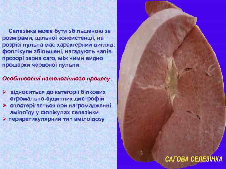 Селезінка може бути збільшеною за розмірами, щільної консистенції, на розрізі пульпа має характерний вигляд: