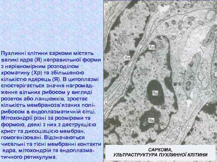 Пухлинні клітини саркоми містять великі ядра (Я) неправильної форми з нерівномірним розподілом хроматину (Хр)