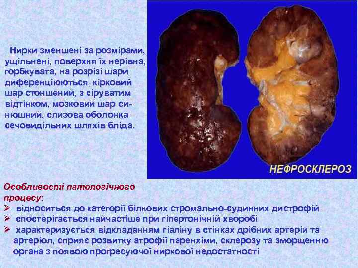 Нирки зменшені за розмірами, ущільнені, поверхня їх нерівна, горбкувата, на розрізі шари диференціюються, кірковий