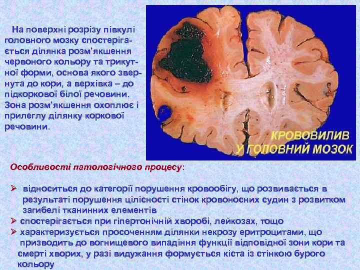 На поверхні розрізу півкулі головного мозку спостерігається ділянка розм’якшення червоного кольору та трикутної форми,