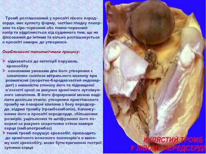 Тромб розташований у просвіті лівого передсердя, має кулясту форму, частіше гладку поверхню та сіро-червоний