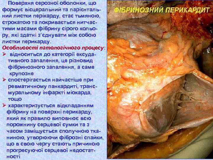 Поверхня серозної оболонки, що формує вісцеральний та парієнтальний листки перікарду, стає тьмяною, строкатою та