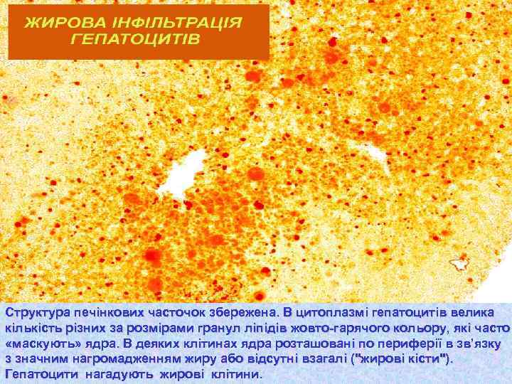Структура печінкових часточок збережена. В цитоплазмі гепатоцитів велика кількість різних за розмірами гранул ліпідів