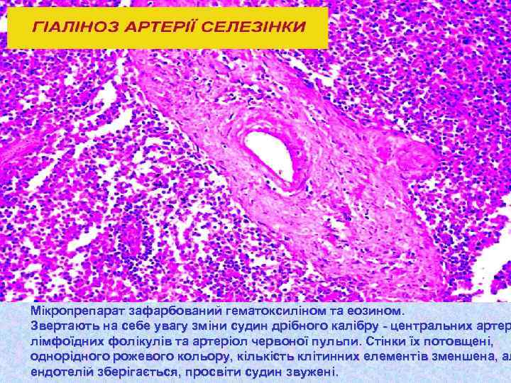 Мікропрепарат зафарбований гематоксиліном та еозином. Звертають на себе увагу зміни судин дрібного калібру -