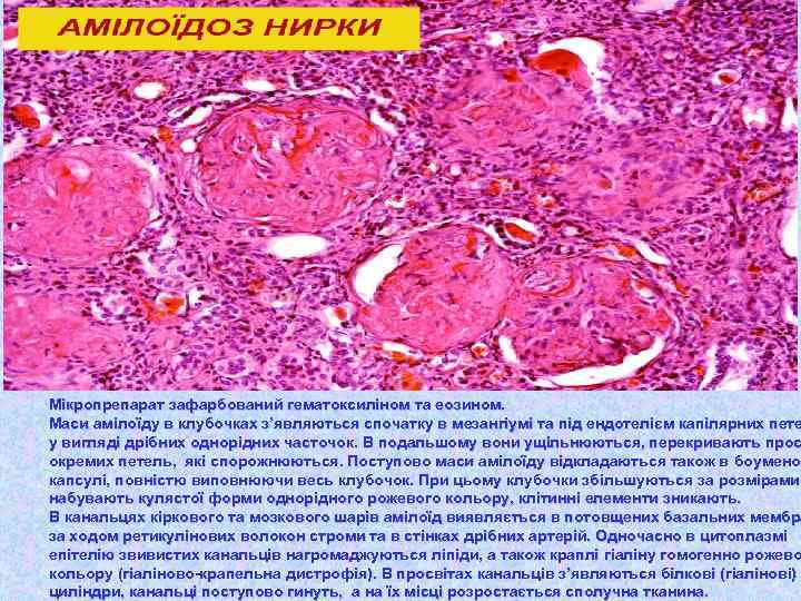 Мікропрепарат зафарбований гематоксиліном та еозином. Маси амілоїду в клубочках з’являються спочатку в мезангіумі та