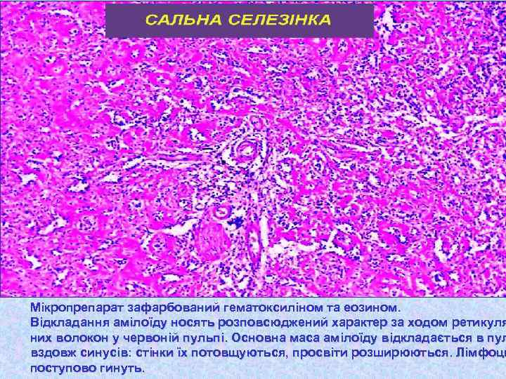 Мікропрепарат зафарбований гематоксиліном та еозином. Відкладання амілоїду носять розповсюджений характер за ходом ретикуля них