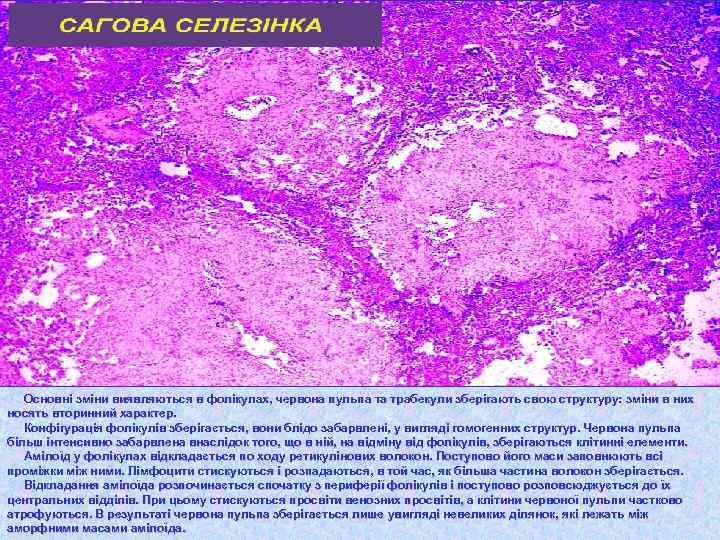 Основні зміни виявляються в фолікулах, червона пульпа та трабекули зберігають свою структуру: зміни в