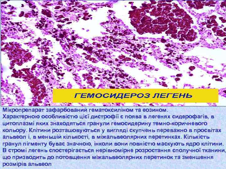 Мікропрепарат зафарбований гематоксиліном та еозином. Характерною особливістю цієї дистрофії є поява в легенях сидерофагів,