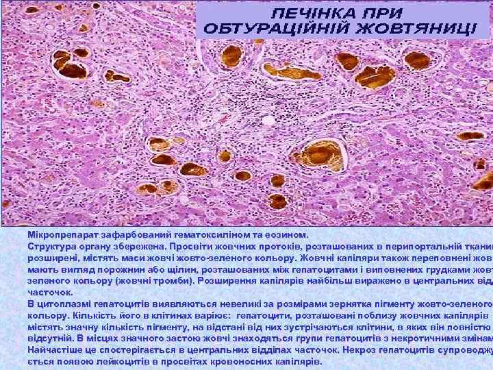 Мікропрепарат зафарбований гематоксиліном та еозином. Структура органу збережена. Просвіти жовчних протоків, розташованих в перипортальній