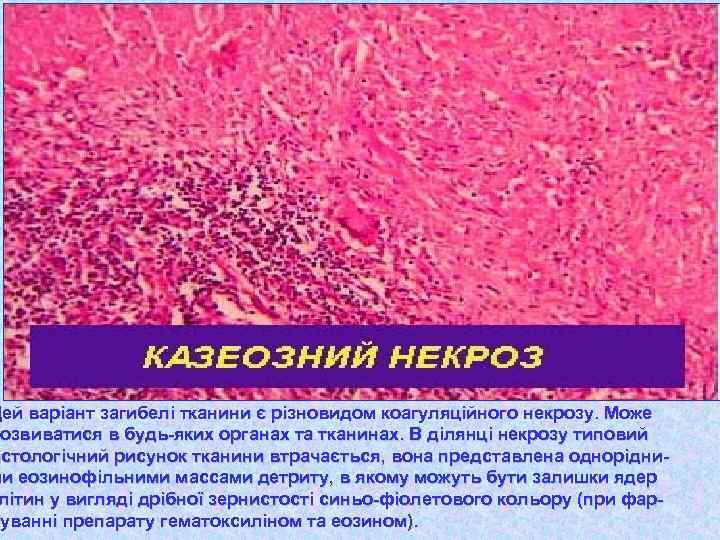 Цей варіант загибелі тканини є різновидом коагуляційного некрозу. Може озвиватися розвиватися в будь-яких органах