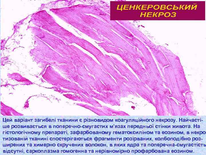 Цей варіант загибелі тканини є різновидом коагуляційного некрозу. Найчастіше розвивається в поперечно-смугастих м’язах передньої